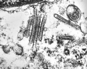 M,7m. | Birbeck granules (Langerhans granules, X-granules) - skin, histiocytosis X